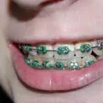 braces