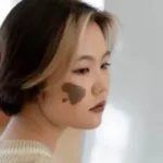 Lady with Birthmarks